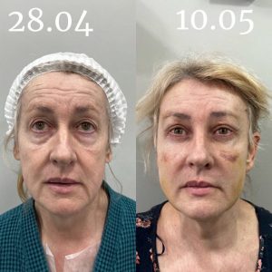 blefaroplastica-pershin-2510 (18)