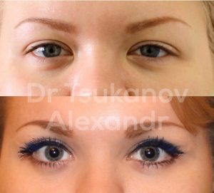 blefaroplastika-cukanov- (1)