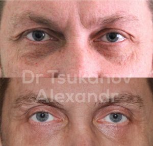 blefaroplastika-cukanov- (10)