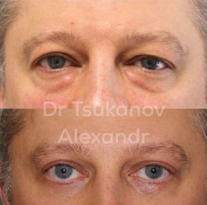 blefaroplastika-cukanov- (11)