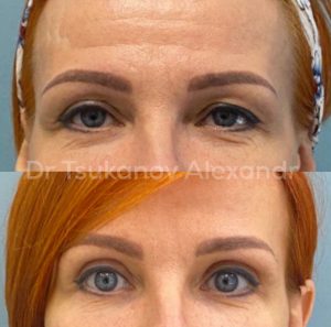 blefaroplastika-cukanov- (2)