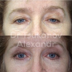 blefaroplastika-cukanov- (3)