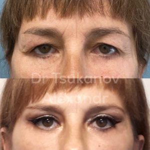 blefaroplastika-cukanov- (4)