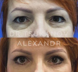 blefaroplastika-cukanov- (5)
