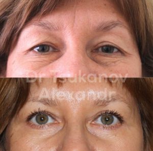 blefaroplastika-cukanov- (6)