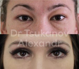 blefaroplastika-cukanov- (7)