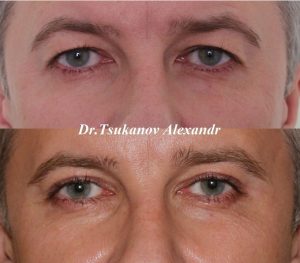 blefaroplastika-cukanov- (8)