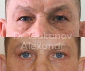 blefaroplastika-cukanov- (9)