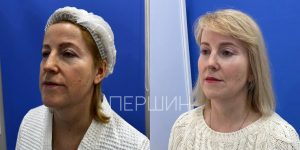 Эндоскопическая подтяжка бровей
