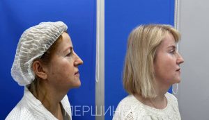 Эндоскопическая подтяжка бровей