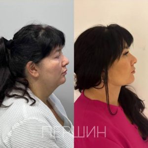 Липосакция «вдовий горб»