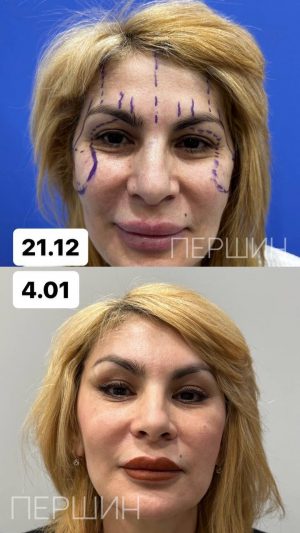 Эндоскопическая подтяжка бровей