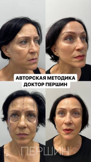 Подтяжка лица  и шеи