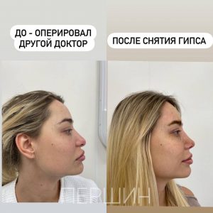 Ринопластика