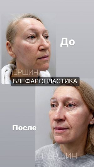 Блефаропластика