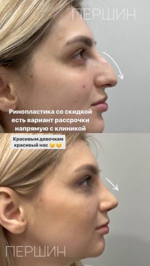 Ринопластика