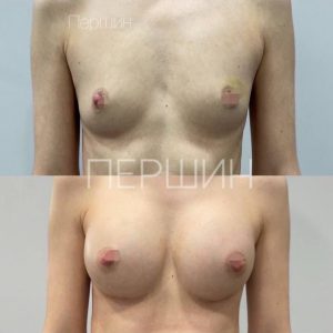 Увеличение груди