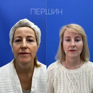 podtyazhka-myagkih-tkaney-sredney-nizhney-treti-lica-i-shei-pershin-2510 (16)