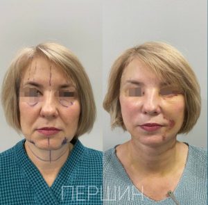 podtyazhka-myagkih-tkaney-sredney-nizhney-treti-lica-i-shei-pershin-2510 (19)