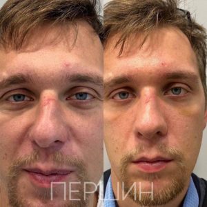 rinoplastika-pershin-2510 (18)