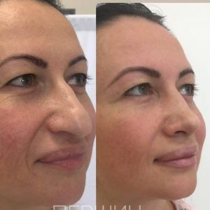 rinoplastika-pershin-2510 (19)