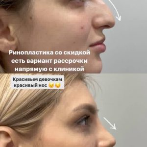 rinoplastika-pershin-2510 (20)