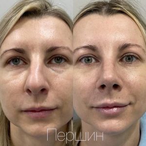 rinoplastika-pershin-2510 (21)
