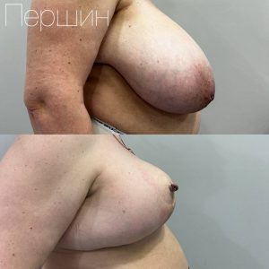 uvelichenie-umenshenie-i-podtyazhka-grudi-pershin-2510 (21)