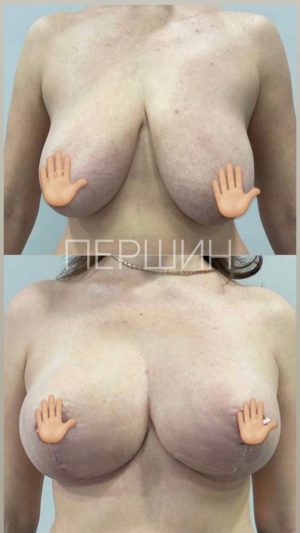 uvelichenie-umenshenie-i-podtyazhka-grudi-pershin-2510 (34)